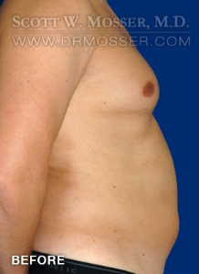 Liposuction - Chest Patient 10587 Before Photo # 5