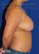 Breast Reduction Patient 20938 After Photo Thumbnail # 6
