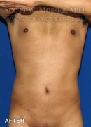 Liposuction - Abdomen & Flanks Patient 52450 After Photo Thumbnail # 2