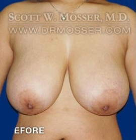 Breast Reduction Patient 54903 Before Photo # 1