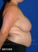 Breast Reduction Patient 24410 Before Photo Thumbnail # 7