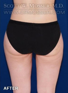 Liposuction - Thighs Patient 40477 After Photo # 4
