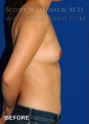 Breast Augmentation Patient 21794 Before Photo Thumbnail # 5