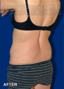 Liposuction - Abdomen & Flanks Patient 75438 After Photo Thumbnail # 4