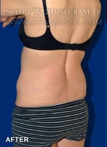 Liposuction - Abdomen & Flanks Patient 75438 After Photo # 4