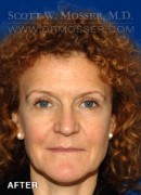 Upper Blepharoplasty Patient 45312 After Photo Thumbnail # 2