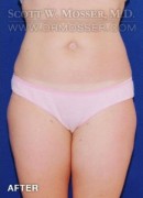 Liposuction - Thighs Patient