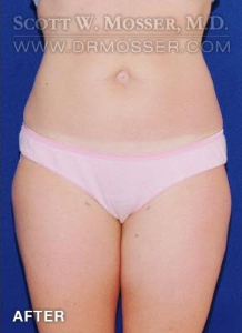 Liposuction - Thighs Patient 42034 After Photo # 2
