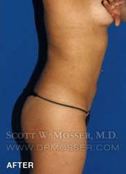 Liposuction - Abdomen & Flanks Patient 33709 After Photo # 8