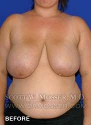 Breast Reduction Patient 24410 Before Photo # 1