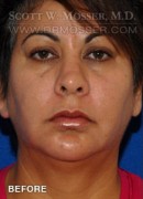 Chin Implant Patient 68063 Before Photo Thumbnail # 1