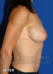 Breast Lift With Implants Patient 19074 After Photo # 8