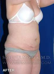 Liposuction - Abdomen & Flanks Patient 26351 After Photo # 4