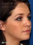 Liposuction - Face Patient 40198 After Photo Thumbnail # 4