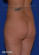 Brazilian Butt Lift Patient 32708 Before Photo Thumbnail # 5