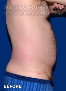 Liposuction - Abdomen & Flanks Patient 23232 Before Photo # 5