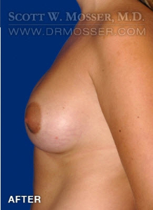 Breast Augmentation Patient 83000 After Photo # 4
