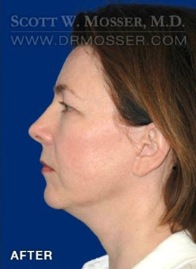 Chin Implant Patient 16572 After Photo # 6