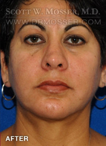 Chin Implant Patient 68063 After Photo # 2