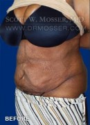 Abdominoplasty Patient 30014 Before Photo Thumbnail # 7