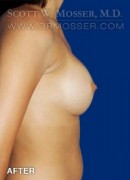 Breast Augmentation Patient 85660 After Photo Thumbnail # 6