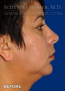 Chin Implant Patient 68063 Before Photo Thumbnail # 5