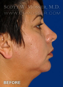 Chin Implant Patient 68063 Before Photo # 5