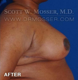 Breast Reduction Patient 91361 After Photo # 6