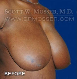 Breast Reduction Patient 70589 Before Photo # 3