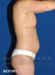 Liposuction - Abdomen & Flanks Patient 98943 Before Photo # 7