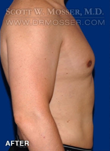 Liposuction - Chest Patient 10587 After Photo # 6