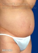 Liposuction - Abdomen & Flanks Patient 68884 Before Photo Thumbnail # 3