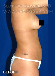 Liposuction - Abdomen & Flanks Patient 53811 Before Photo # 5