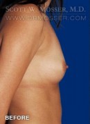 Breast Augmentation Patient 24873 Before Photo Thumbnail # 5