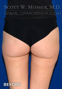 Liposuction - Thighs Patient 10722 Before Photo # 1