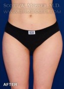 Liposuction - Thighs Patient 40477 After Photo Thumbnail # 2