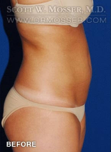 Liposuction - Abdomen & Flanks Patient 39576 Before Photo # 3