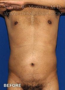 Liposuction - Chest Patient 51091 Before Photo # 11