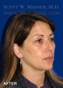 Upper Blepharoplasty Patient 94858 After Photo Thumbnail # 4