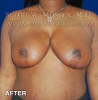 Breast Reduction Patient 70589 After Photo Thumbnail # 2