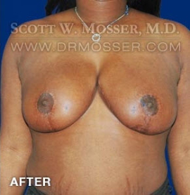 Breast Reduction Patient 70589 After Photo # 2