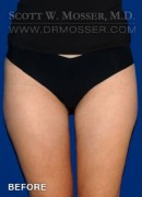 Liposuction - Thighs Patient 10722 Before Photo Thumbnail # 3