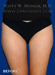 Liposuction - Thighs Patient 10722 Before Photo # 3