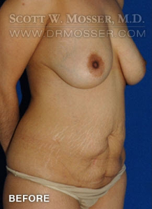 Abdominoplasty Patient 81038 Before Photo # 5