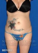 Liposuction - Abdomen & Flanks Patient 81638 Before Photo Thumbnail # 1