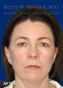 Chin Implant Patient 16572 After Photo # 2