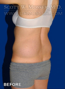 Liposuction - Abdomen & Flanks Patient 75438 Before Photo # 3