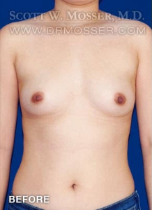 Breast Augmentation Patient 66017 Before Photo # 1
