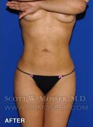 Liposuction - Abdomen & Flanks Patient 33709 After Photo # 2