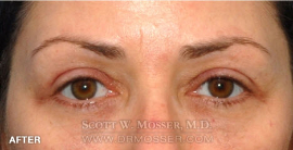 Lower Blepharoplasty Patient 88372 After Photo # 2